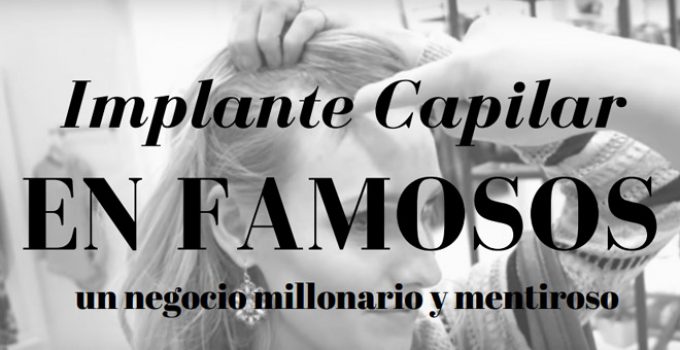 tratamientos para la calvicie